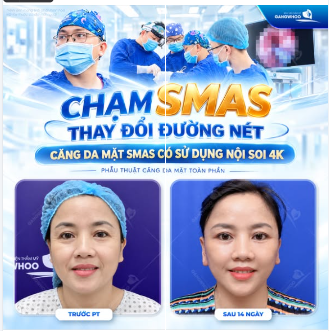 CHẠM SMAS – THAY ĐỔI ĐƯỜNG NÉT SAU 1 LẦN THỰC HIỆN
