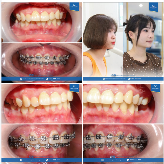 Răng đều rồi tại sao Hồ Thúy vẫn phải niềng?