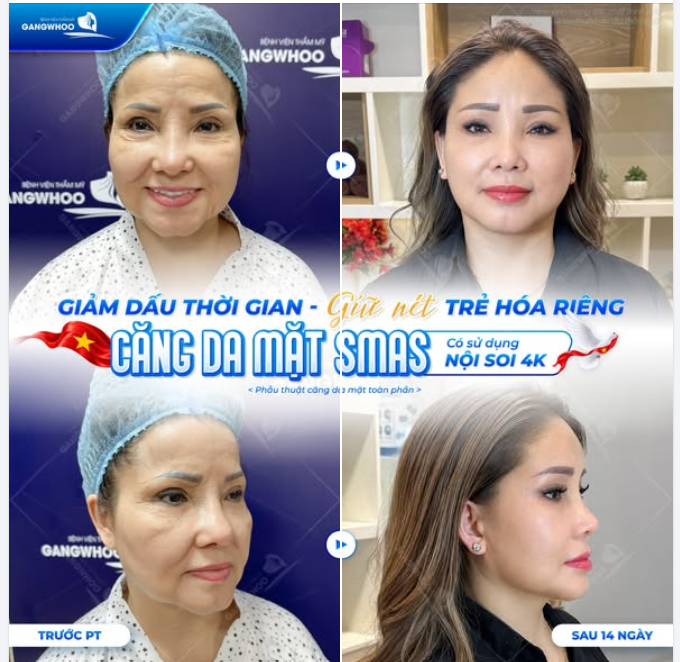 GIẢM DẤU THỜI GIAN – GIỮ NÉT TRẺ HÓA RIÊNG