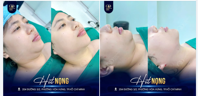 TỰ TIN MỌI GÓC NGHIÊNG – THẤY NGAY KẾT QUẢ NGAY SAU 45 PHÚT