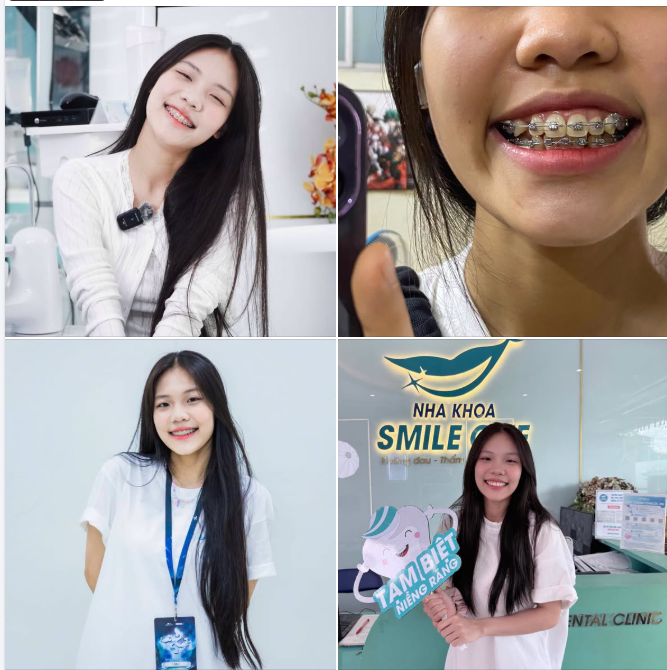 NIỀNG RĂNG MẮC CÀI CỔ ĐIỂN. TÔN TRỌNG.