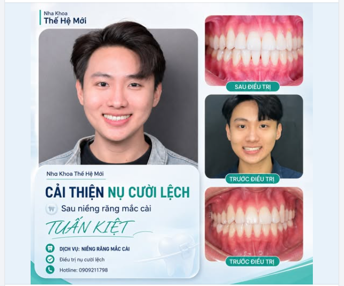 CƯỜI LỆCH – NIỀNG RĂNG CÓ CẢI THIỆN ĐƯỢC KHÔNG?