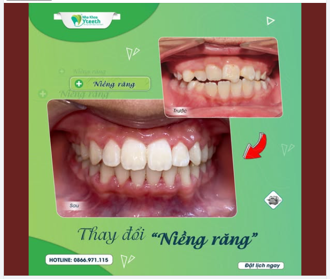Mới gắn mắc cài ăn uống thế nào?