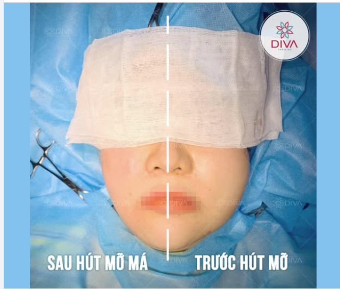Vì sao có người đi hạ gò má xong thì mặt càng phính và chảy xệ nhiều hơn?