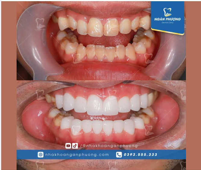 Xử lý một ca răng nhiễm màu cho anh Quang Dương