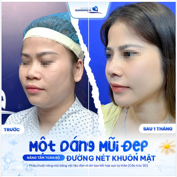 MỘT DÁNG MŨI ĐẸP NÂNG TẦM TOÀN BỘ ĐƯỜNG NÉT KHUÔN MẶT