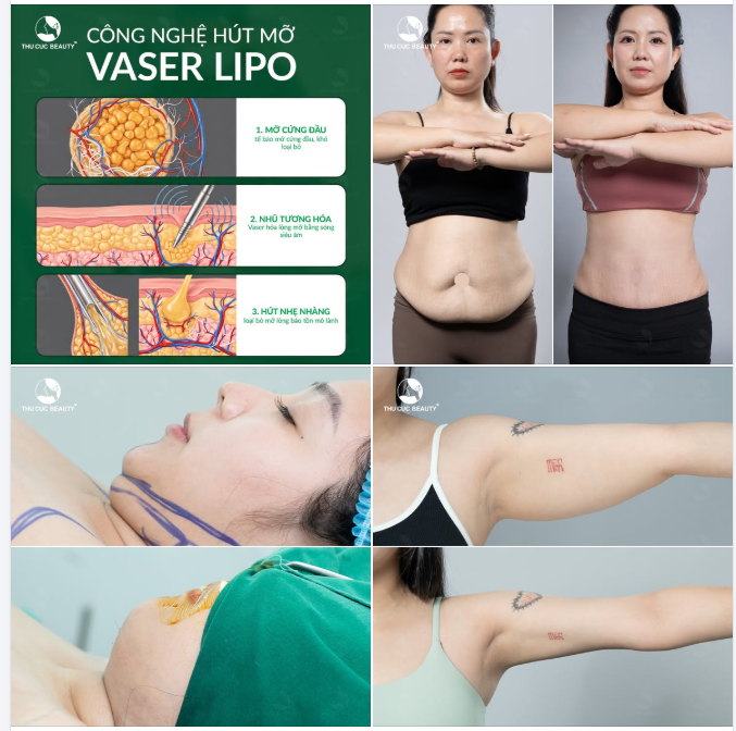 Mỡ thừa lâu năm khiến bạn luôn tự ti