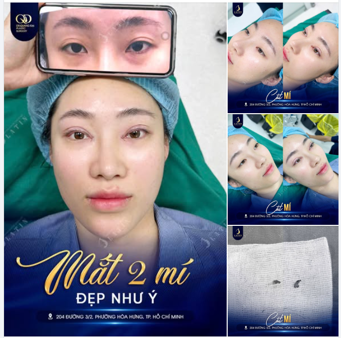 TẠM BIỆT MÍ LÓT – SỞ HỮU ĐÔI MẮT 2 MÍ RÕ NÉT NGAY TRÊN BÀN MỔ