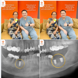 TỪ MỘT CA TRỒNG RĂNG ĐẾN NIỀM TIN CỦA CẢ GIA ĐÌNH