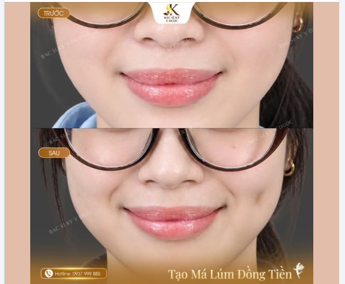 TẠO MÁ LÚM ĐỒNG TIỀN – NÉT DUYÊN NHẸ NHÀNG