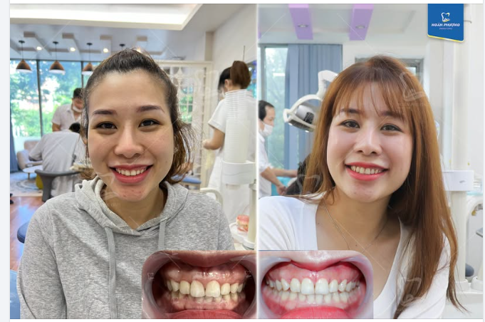 Cắt lợi là gì? Có hết hở lợi, không tái phát nữa không?