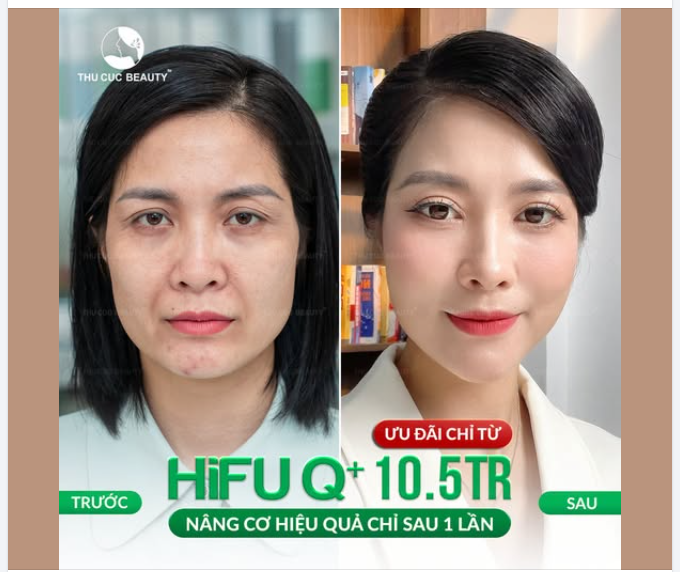 Lấy lại thần thái trẻ trung cùng HiFU Q+ tại Thu Cúc