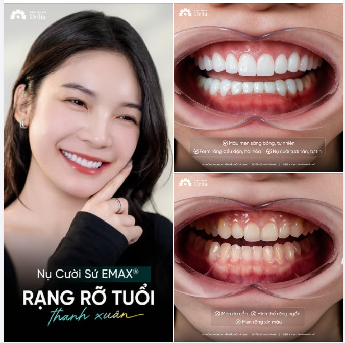 Đổi răng ố vàng lấy nụ cười răng sứ đẹp - tự tin