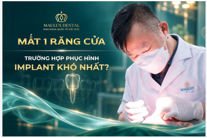 MẤT MỘT RĂNG CỬA - VÌ SAO ĐÂY LÀ CA KHÓ TRONG IMPLANT?