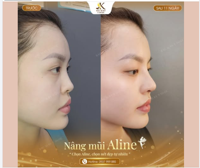 Chọn Aline – chọn một dáng mũi đẹp theo cách rất riêng của bạn.