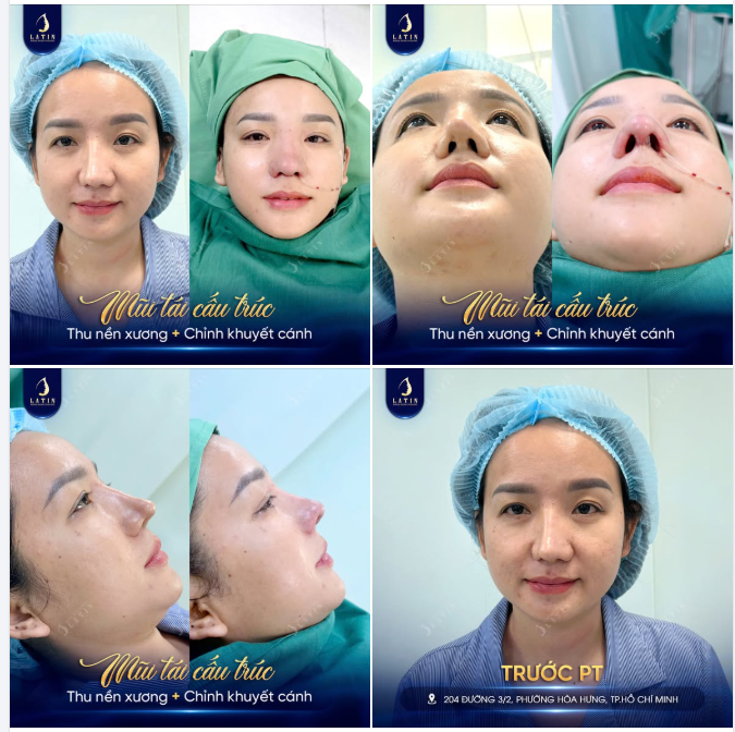 "GIẢI CỨU" DÁNG CŨ THÔ CỨNG, ĐỊNH HÌNH ĐƯỜNG NÉT MỚI VỚI MŨI TÁI CẤU TRÚC