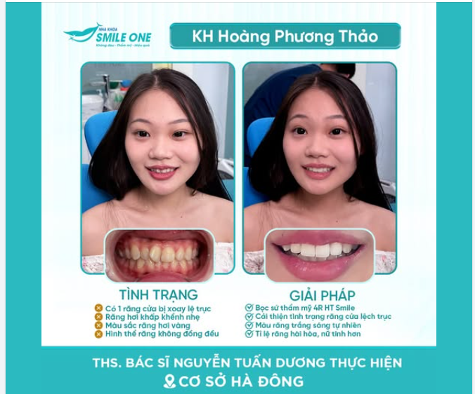ĐỪNG ĐỂ NỤ CƯỜI BỊ CHE GIẤU BỞI 1 CHIẾC RĂNG CỬA XOAY LỆCH