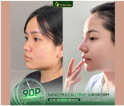 NÂNG MŨI CẤU TRÚC SURGIFORM – ĐẸP XUẤT SẮC NGAY SAU 90 PHÚT PHẪU THUẬT