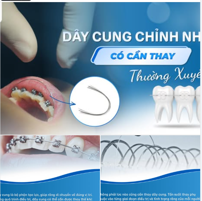 DÂY CUNG CHỈNH NHA CÓ CẦN THAY THƯỜNG XUYÊN