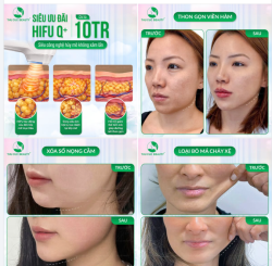 SIÊU ƯU ĐÃI HIFU Q+ CHỈ TỪ 10 TRIỆU CHÀO ĐÓN THÁNG CỦA NÀNG