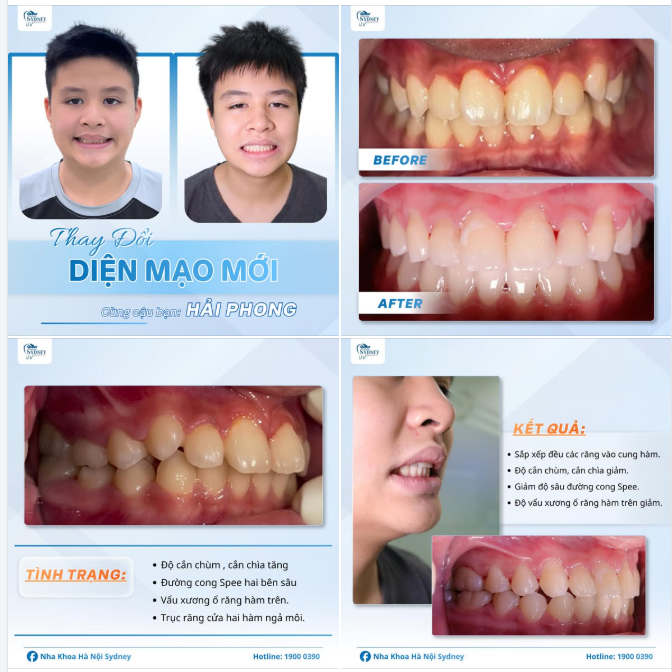 THAY ĐỔI DIỆN MẠO CÙNG CẬU BẠN HẢI PHONG
