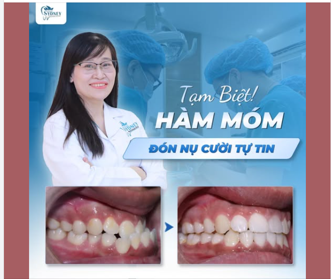 TẠM BIỆT HÀM MÓM – ĐÓN NỤ CƯỜI TỰ TIN