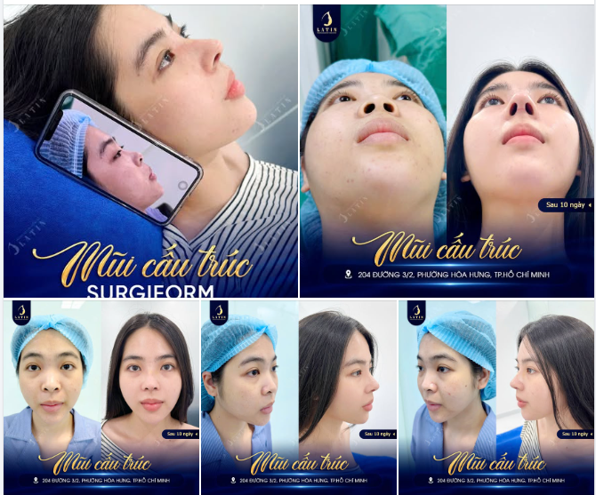 NÂNG MŨI CẤU TRÚC SURGIFORM – GÓC NGHIÊNG RÕ NÉT SAU 10 NGÀY