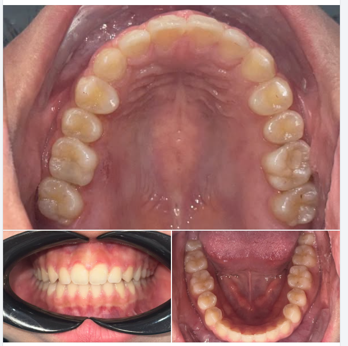 Niềng Răng Bằng Invisalign So Với Niềng Răng Truyền Thống