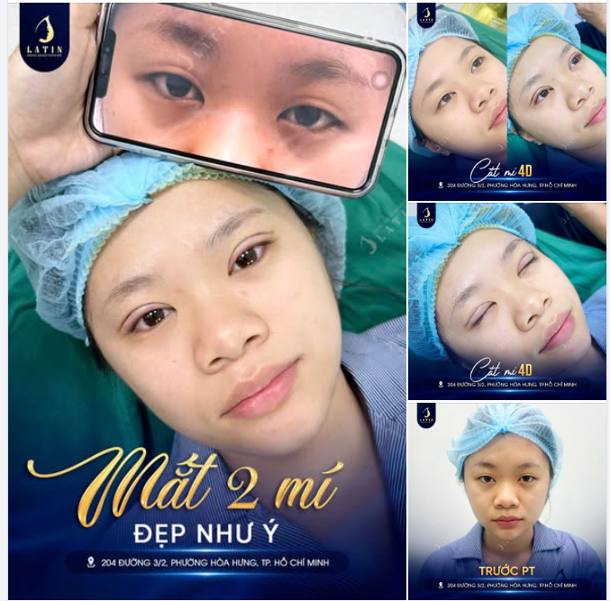 C.ẮT MÍ 4D – CHÌA KHÓA CHO ÁNH NHÌN SÁNG TRONG VÀ CUỐN HÚT