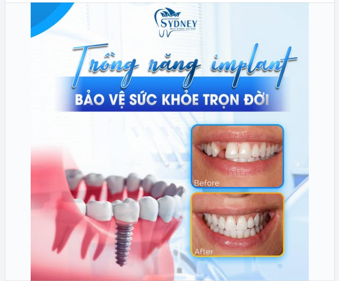 TRỒNG RĂNG IMPLANT - BẢO VỆ SỨC KHỎE TRỌN ĐỜI