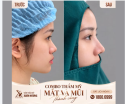 COMBO MŨI - MÍ GIÚP GÓC NGHIÊNG THÊM CUỐN HÚT