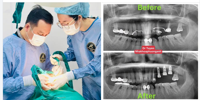 Ai Là Người Phù Hợp Để Làm Implant Răng?