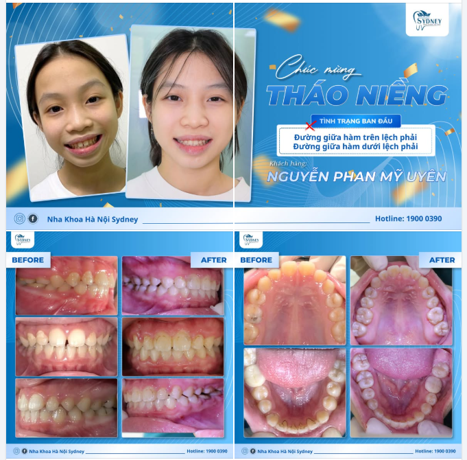 CHÚC MỪNG THÁO NIỀNG KHÁCH HÀNG MỸ UYÊN