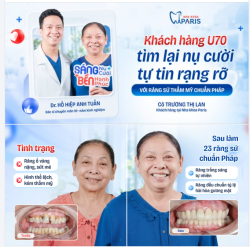 KHÁCH HÀNG U70 TÌM LẠI NỤ CƯỜI TỰ TIN RẠNG RỠ VỚI RĂNG SỨ CHUẨN PHÁP!