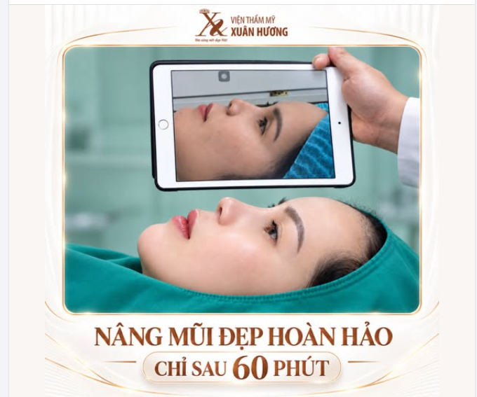 NÂNG MŨI ĐẸP HOÀN HẢO CHỈ SAU 60 PHÚT CÙNG Bs QUANG VTM XUÂN HƯƠNG