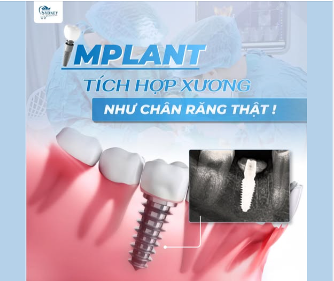 IMPLANT TÍCH HỢP XƯƠNG NHƯ CHÂN RĂNG THẬT
