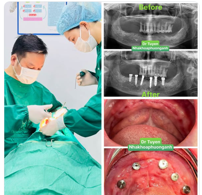 Concept: All-on-X Implant toàn hàm và phục hình tạm trong 24h.