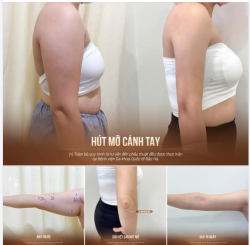 TẠM BIỆT BẮP TAY TO THÔ – ĐÓN DÁNG TAY THANH MẢNH SAU 15 NGÀY!