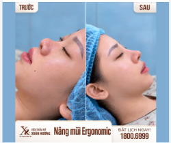 NÂNG MŨI ERGONOMIC – TÔN VINH VẺ ĐẸP TỪ MỌI GÓC NHÌN!