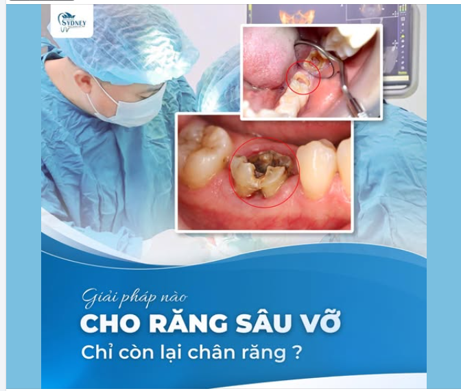 GIẢI PHÁP NÀO CHO RĂNG SÂU VỠ CHỈ CÒN LẠI CHÂN RĂNG?