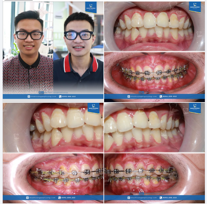 Khi niềng răng không chỉ là vì một nụ cười khỏe đẹp