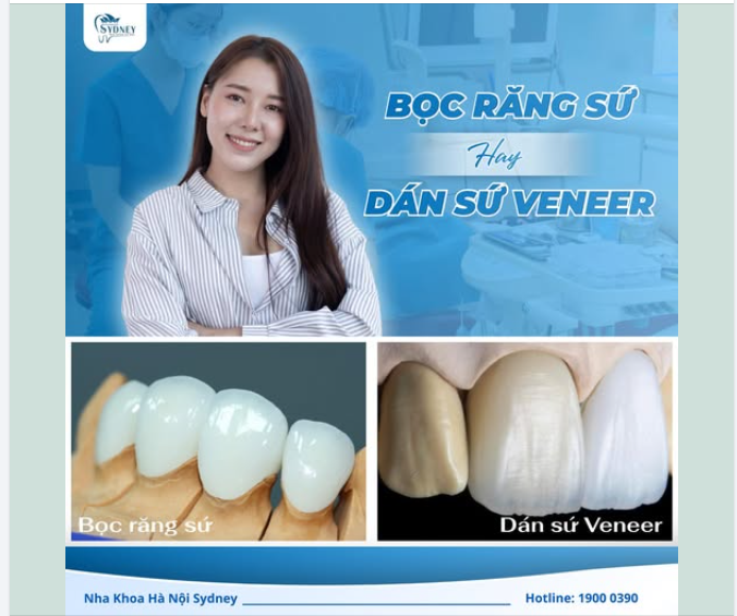 BỌC RĂNG SỨ HAY DÁN SỨ VENEER?