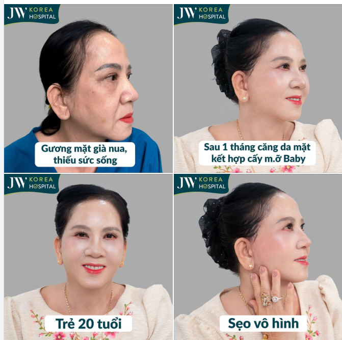 U70 SAU NHIỀU NĂM LO CHO CHỒNG CON, ĐƯỢC CHỒNG ĐÍCH THÂN ĐƯA ĐẾN BÁC SĨ TÚ DUNG CĂNG DA MẶT KẾT HỢP CẤY MỠ BABY TÌM LẠI 20 NĂM TUỔI XUÂN