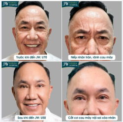 BÁC SĨ JW BỎ BỌNG M.Ỡ, XÓA ΝΗĂN CAU MÀY CHO U70 VIỆT KIỀU MỸ TRẺ TRUNG PHONG ĐỘ NHƯ U50