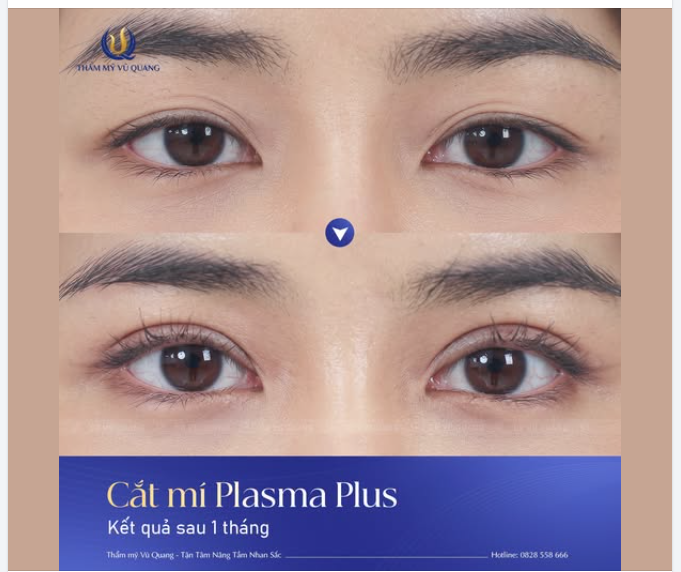 Diện mạo mới tràn đầy sức hút sau 1 tháng cắt mí Plasma Plus!