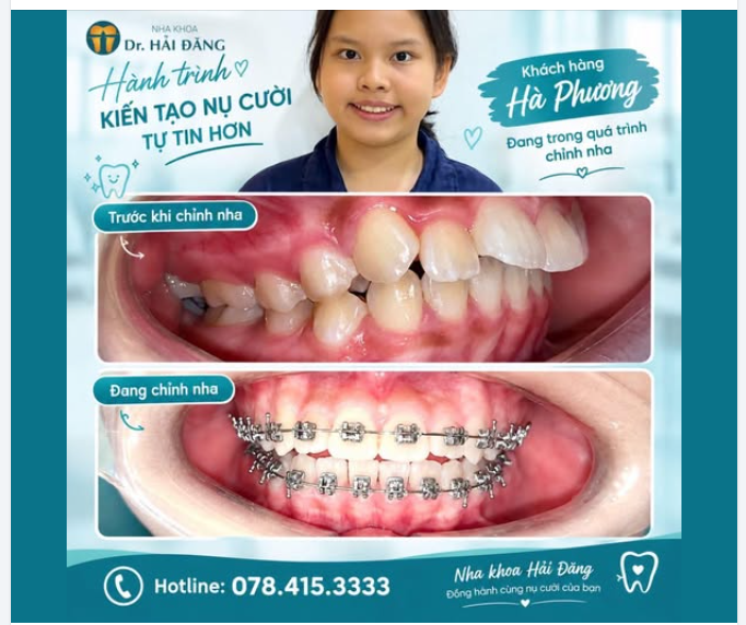 ĐỘ TUỔI VÀNG CHỈNH NHA – HÀNH TRÌNH CỦA HÀ PHƯƠNG