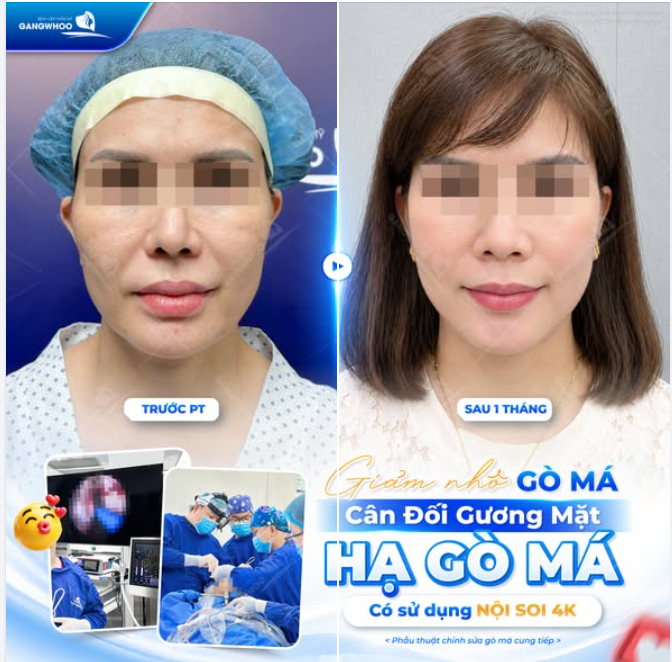GIẢM NHÔ GÒ MÁ - CÂN ĐỐI GƯƠNG MẶT - HẠ GÒ MÁ CÓ SỬ DỤNG NỘI SOI 4K