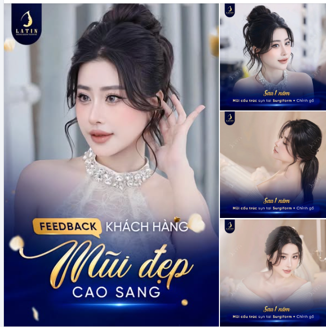 CHỈNH GỒ – NÂNG MŨI CẤU TRÚC SURGIFORM:  NHÌN LẠI DÁNG M.ŨI SAU 1 NĂM