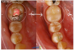 CHỮA TỦY XONG - VẪN CÒN MỘT BƯỚC QUAN TRỌNG