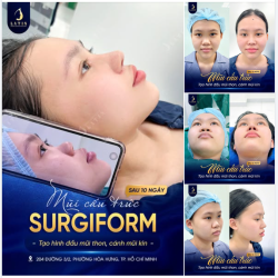 SỐNG MŨI RÕ NÉT – ĐIỂM NHẤN CHO GÓC NGHIÊNG THANH TÚ